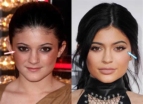 Kylie Jenner, Before and After Transformation