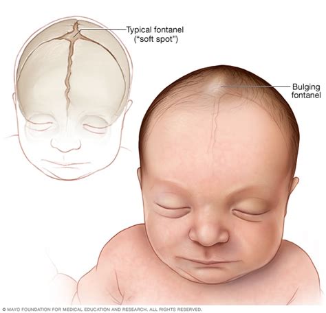 Here’s Everything You Need To Know About Encephalitis - ScoopWhoop