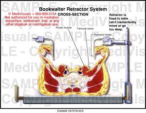 Bookwalter Retractor System Medical Illustration Medivisuals