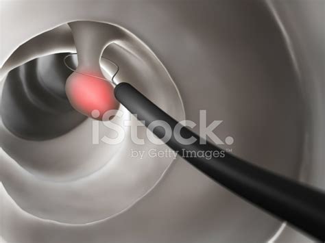 Polyp Removal Stock Photos - FreeImages.com