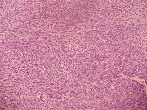 GLIOSARCOMA (ATLAS) – Histopathology.guru