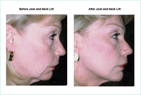 Neck & Jowl Lift Austin, Texas | Central Texas Dermatology