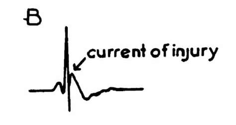 Osborn Wave (J Wave) • LITFL • ECG Library Basics