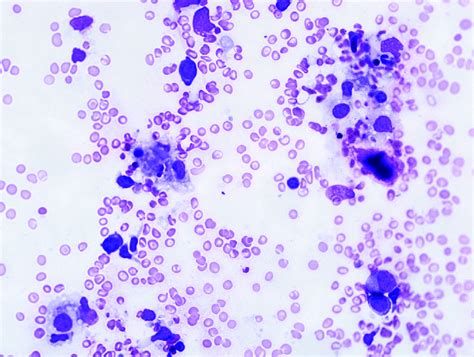 hemophagocytosis found on BM aspirate (case 12). | Download Scientific Diagram