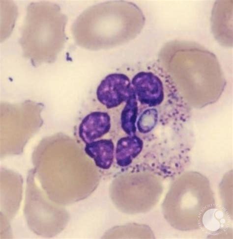 Histoplasma capsulatum in peripheral blood smear