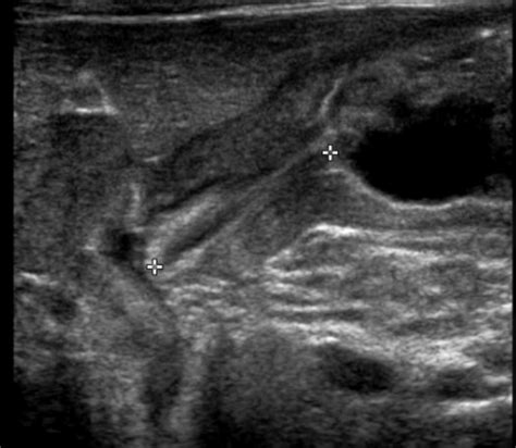 Pyloric Stenosis Ultrasound