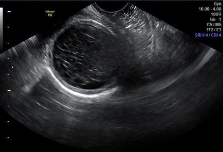 Haemorrhagic ovarian cyst | Radiology Reference Article | Radiopaedia.org