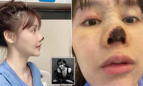 Woman Shows Botched Plastic Surgery Which Turned Her Nose Black With ...