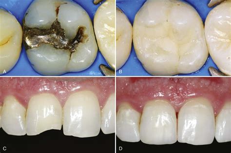 8: Introduction to Composite Restorations | Pocket Dentistry