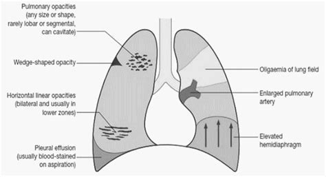 Pulmonary Embolism : Chest X-ray Signs | Epomedicine