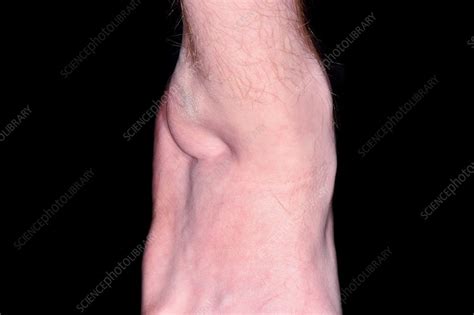 Club foot following surgery in childhood - Stock Image - C034/5425 - Science Photo Library