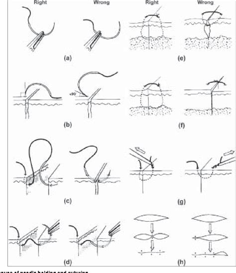 Sutures and suturing techniques in skin closure. | Semantic Scholar