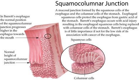 Barrett Esophagus | Diseases & Conditions | 5MinuteConsult