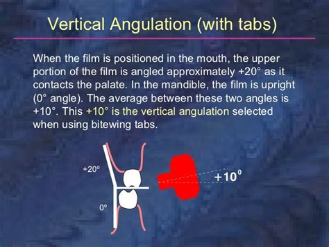 radiology-bitewing-technique