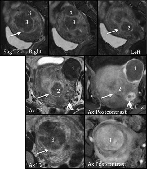 Multiple fibroids in the same patient. The straight white arrows ...