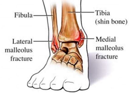 Medial Malleolus Fracture - Treatment, Symptoms, ICD 10, Causes, What