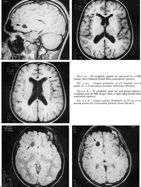 Figure 2 from MRI AND ASYMPTOMATIC COARCTATION OF THE FRONTAL LATERAL VENTRICLE HORN | Semantic ...