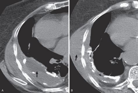 Pleural Effusion | Radiology Key