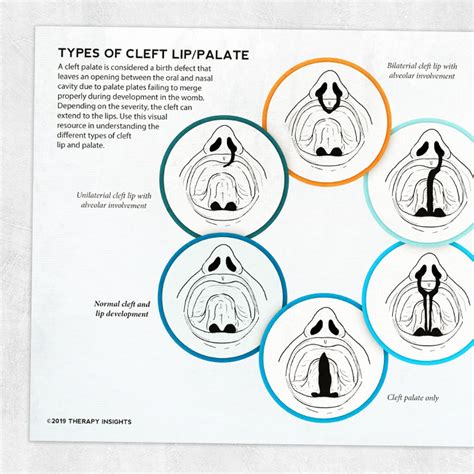 Types of Cleft Lip/Palate – Adult and pediatric printable resources for speech and occupational ...