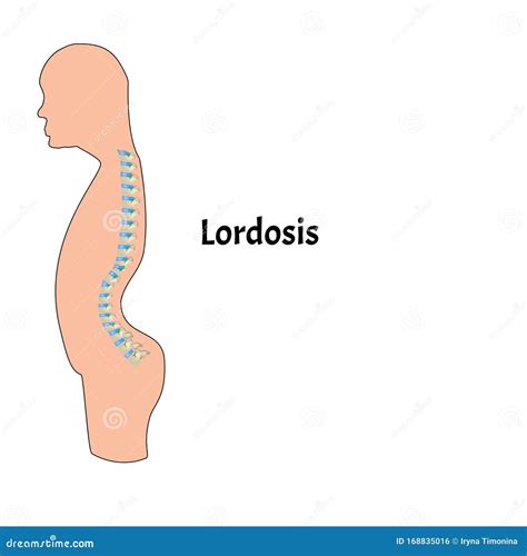 Improper Posture Symptoms. Text Neck Syndrome. Spinal Curvature ...