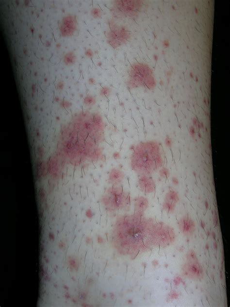 Rash on extremities | MDedge Family Medicine