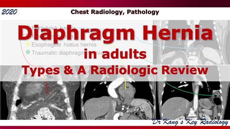 Diaphragm Hernia in Adults, Types and A Radiologic Review - YouTube