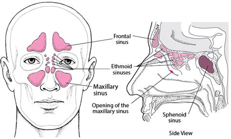 Sinusitis - Ear, Nose, and Throat Disorders - Merck Manuals Consumer Version (2022)