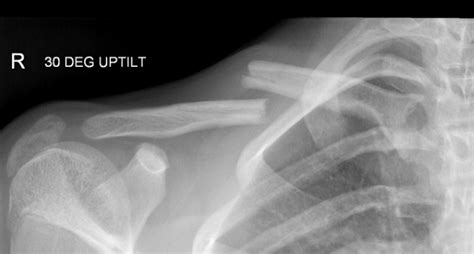 Clavicle Fracture | Shoulder Injuries | Dr. Christopher Ahmad