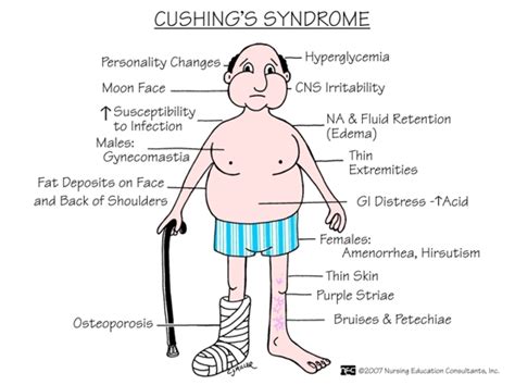 Cushing's Syndrome: Signs and Symptoms