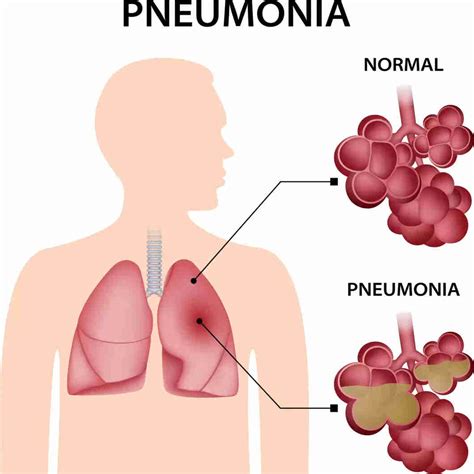 Pneumonia Vaccine: Purpose, Dosage & Side Effects