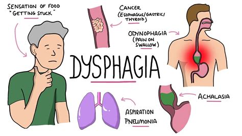 Dysphagia Treatment - Neuromedy