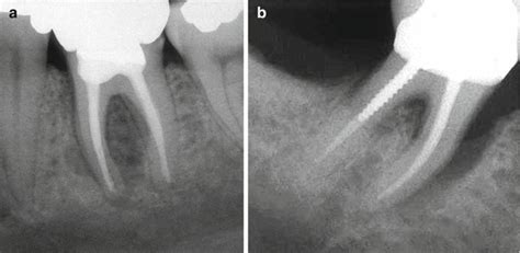 Diagnosis of Vertical Root Fractures | Pocket Dentistry