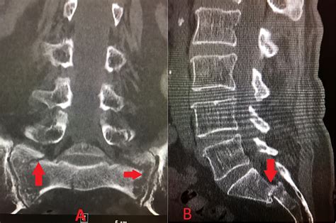 Cureus | Combined Sacroplasty and Iliosacral Fixation Using Triangular Titanium Implants for the ...