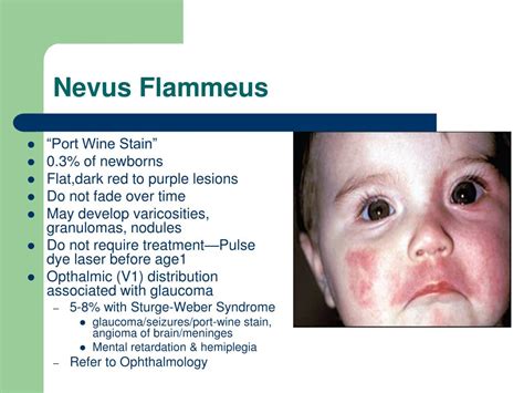 Nevus Flammeus