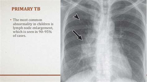 Radiographic manifestations of pulmonary tuberculosis