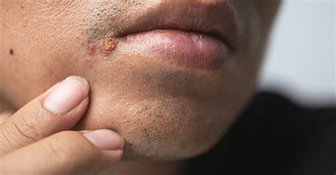 Herpes Pictures On Lips Symptoms | Lipstutorial.org