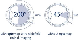 Optomap vs. Dilation — Eyes on the City - Ballard - Vision Source