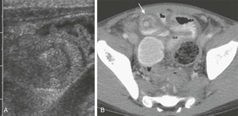 Intussusception | Radiology Key