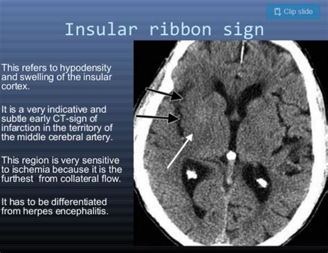 Acute Infarction (6-48 hrs) - The loss of the insular ribbon sign refers to a loss of definition ...