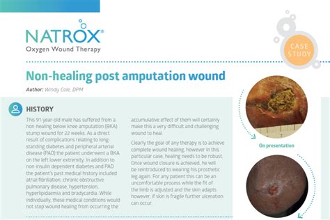 NATROX® | Non-healing post amputation wound