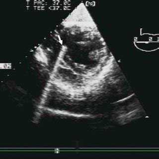 Transesophageal echocardiography (TEE) after admission; short-axis view ...