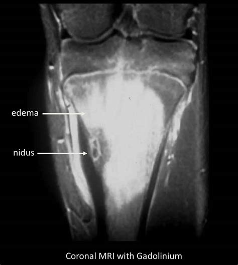 Osteoid Osteoma Spine Mri