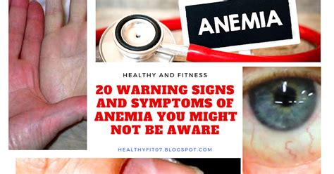 20 Warning Signs And Symptoms Of Anemia You Might Not Be Aware