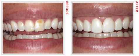 The Differences Between Veneers and Bonding You Probably Didn’t Know - NewBeauty