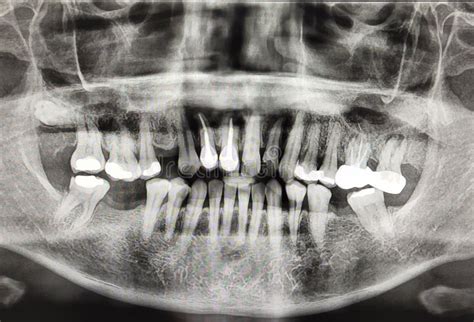 Panoramic Radiograph Skull Full Mouth X-ray Human Disease Oral Surgery Dentistry Teeth Patient ...