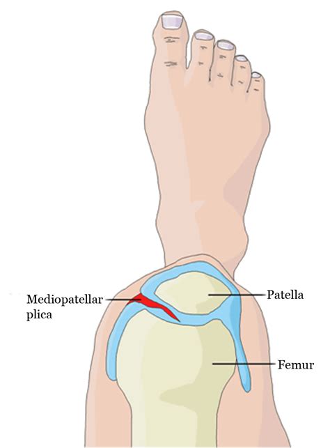 FULL TEXT - Plica syndrome and its embryological origins - Edorium ...