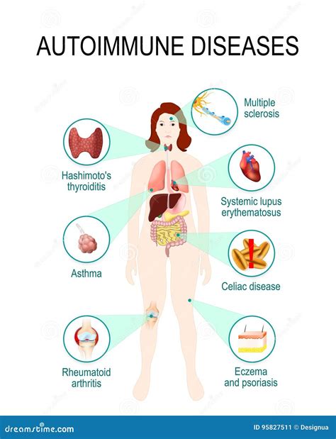 Autoimmune sjukdomar vektor illustrationer. Illustration av ...