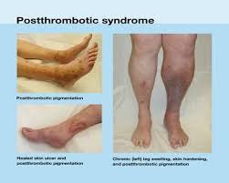 Prepare for Medical Exams : Post- thrombotic Syndrome