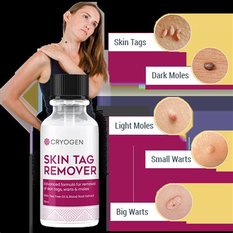 In 5 Best Skin Tag Remover -Cryogen Skin Tag Remover Reviews