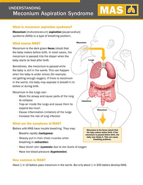 Meconium Aspiration Syndrome (MAS) - NICU Parent Education Resources